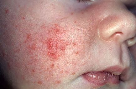 Herpes la copil pe simptomele feței și tratament