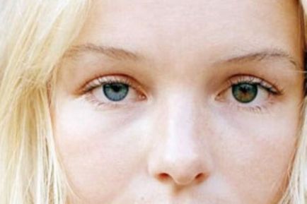 Heterochromia - o boală sau o condiție unică