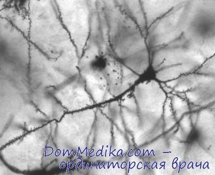 Giant neuropatia axonală și sindromul Guillain-Barre provoacă, diagnosticul, tratamentul