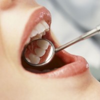 Tratamentul gingivitelor în stomatologie cum să tratați, cauzează, tratamentul stomatologic