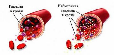 Hiperglicemia în diabet zaharat ceea ce este, cauzele, tratament