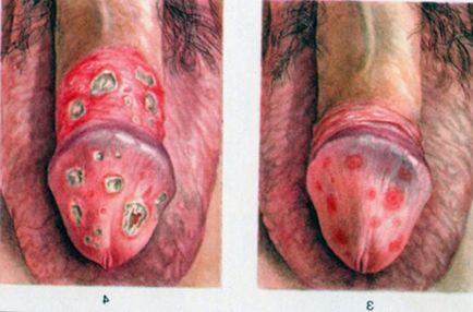 Грибок на статевому члені фото, як виглядає, лікування