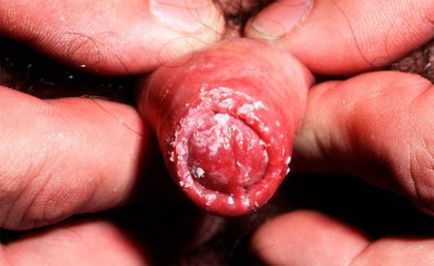 Ciuperca pe poza penisului, cum arata, tratamentul