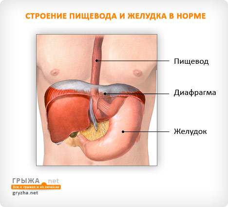 Hernia simptomelor și tratamentului esofagului și diafragmei