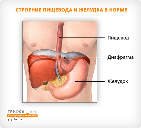 Грижа стравохідного отвору діафрагми симптоми і лікування