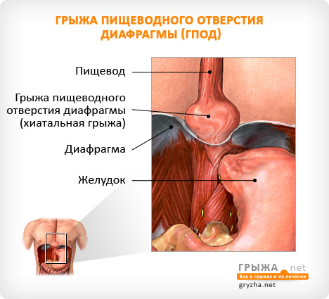 Hernia simptomelor și tratamentului esofagului și diafragmei