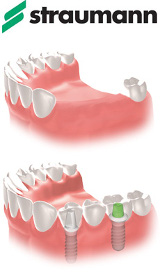 імплантати straumann