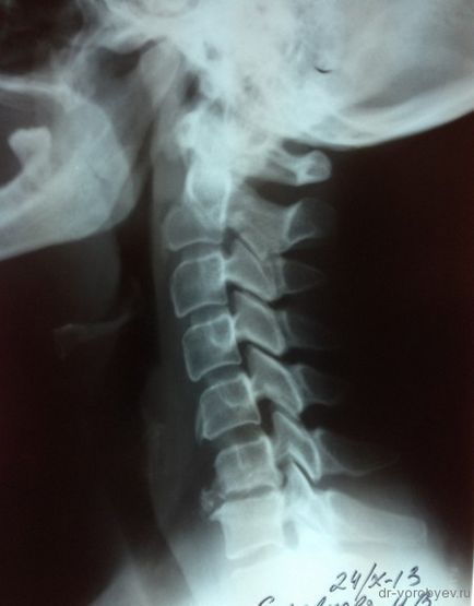 Az implantátumok a nyaki gerinc, idegsebészet (nyaki) Az implantátumok a nyaki gerinc, idegsebészet