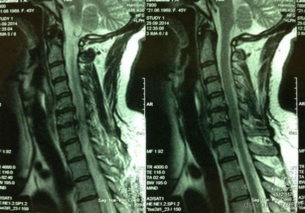 Az implantátumok a nyaki gerinc, idegsebészet