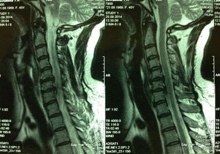 Az implantátumok a nyaki gerinc, idegsebészet (nyaki) Az implantátumok a nyaki gerinc, idegsebészet