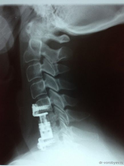Az implantátumok a nyaki gerinc, idegsebészet (megye) Az implantátumok a nyaki gerinc, idegsebészet
