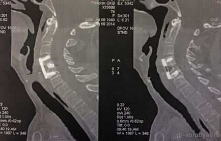 Az implantátumok a nyaki gerinc, idegsebészet