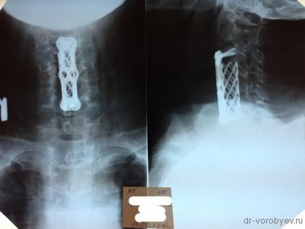 Az implantátumok a nyaki gerinc, idegsebészet