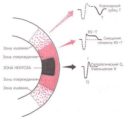 Infarctul miocardic patofiziologic - tratamentul inimii