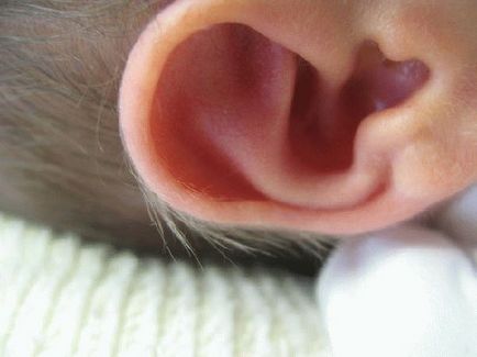 Інфекція вуха у новонароджених - симптоми, лікування і профілактика