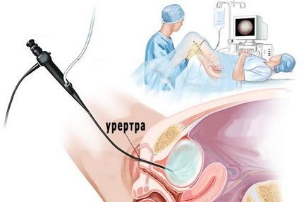 Diagnosticarea cistitei interstițiale 3 criterii, simptome și tratament importante