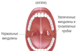 Care sunt complicațiile după angină