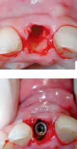 Ce măsuri trebuie luate după eliminarea dintelui molar, a academiei de zâmbet