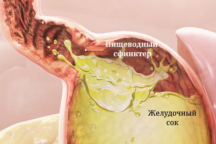 Як позбутися від печії причини появи і симптоми печії