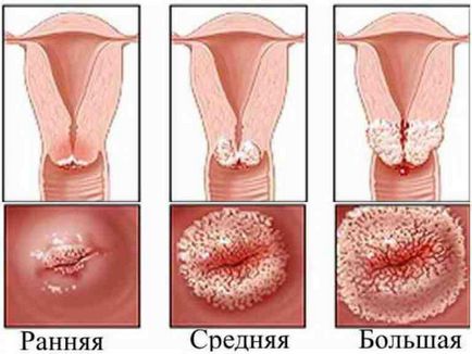 Cum să tratați eroziunea cervicală prin remedii folclorice