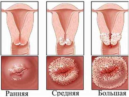 Как за лечение на рак на маточната шийка ерозия народни средства