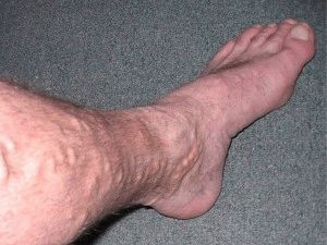 Як лікувати варикоз на ногах у чоловіків методи і рекомендації
