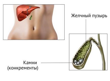 Hogyan lehet eltávolítani a köveket az epehólyag