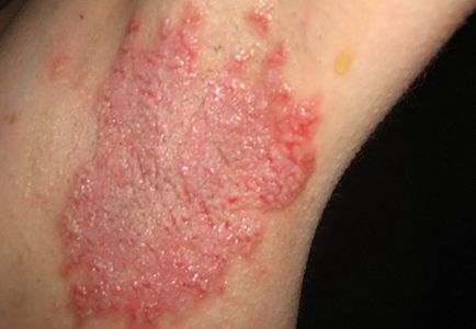 Кандидоз шкіри що це таке, симптоми і лікування у чоловіків