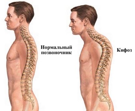 Кіфоз хребта ступеня і виправлення