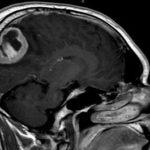 Meningioamele cistice ale creierului, un jurnal de articole medicale 