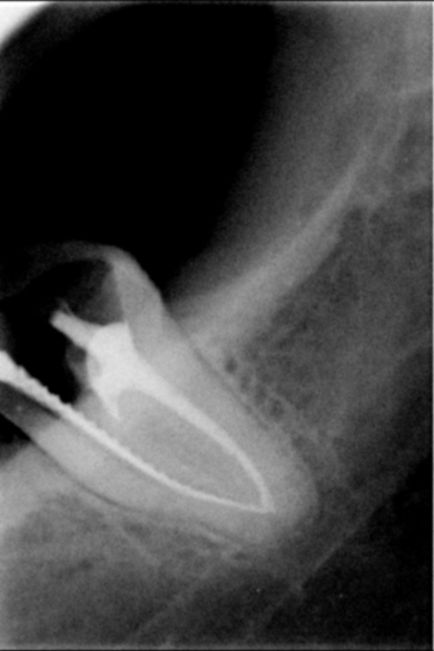 Tratamentul clasic-dent al pulpitei dintelui