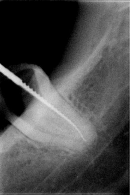 Tratamentul clasic-dent al pulpitei dintelui