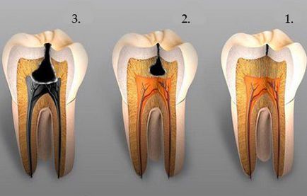 Класик-дент лікування пульпіту зубів