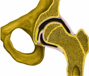 Coxarthrosis csípőízületeknél