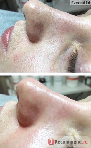 Комбінована чистка обличчя - «найкраща процедура для проблемної шкіри! Але що може бути не так фото