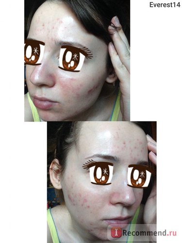 Комбінована чистка обличчя - «найкраща процедура для проблемної шкіри! Але що може бути не так фото
