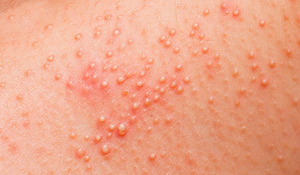 Kontakt dermatitis - Tünetek és kezelés Felnőttek és gyermekek