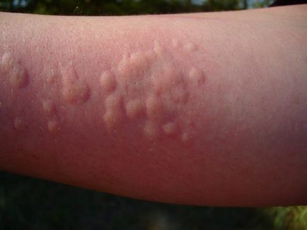 Urticaria Causes, tünetek és kezelési módszerek