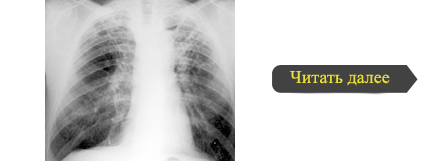 Diagnosticul clinic al tuberculozei