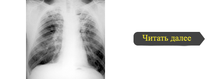 Diagnosticul clinic al tuberculozei