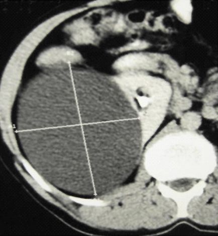 Îndepărtarea laparoscopică a chistului renal gigantic - cercetare de bază (jurnal științific)