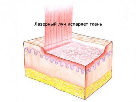 Resurfacarea cu laser a cicatricilor și preparării cicatricilor, contraindicații, rezultate ale procedurilor foto, preț