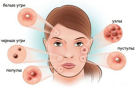Tratamentul acneei pe față cu medicamente și produse cosmetice