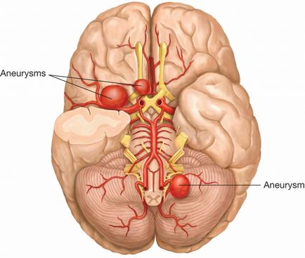 Tratamentul anevrismelor cerebrale în germaniu, prețuri, clinici