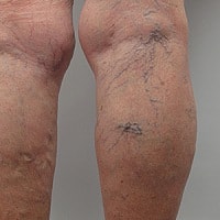 Лікування атеросклерозу судин нижніх кінцівок сучасне лікування ніг лазером, лікування варикозу