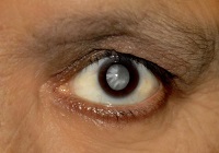 Лікування катаракти очей оперативне, вітаміни, консервативне, вправи