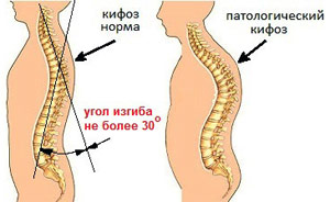 Tratamentul ciumzei coloanei vertebrale la adulți 1, 2 și 3 grade pe care medicul le va ajuta, va prescrie tratament terapeutic