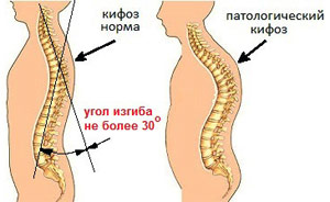 Лікування кіфозу хребта у дорослих 1, 2 і 3 ступеня який лікар допоможе, призначить лікувальні