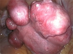 Tratamentul fibromilor uterini