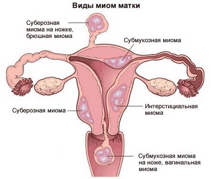 Лікування міоми матки